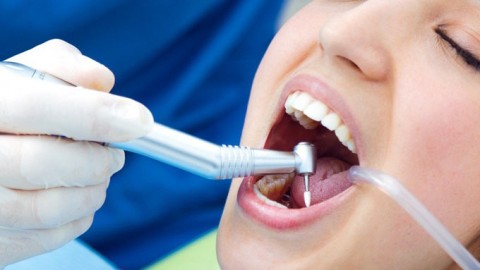 Có thể tẩy trắng răng sau khi trám không ?